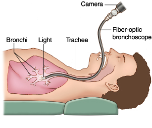 Bronchoscopy Biopsy